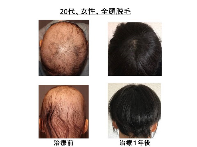 円形脱毛症　病院